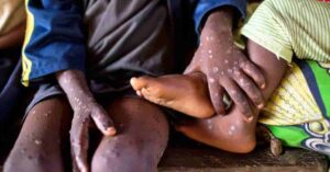 Mpox outbreak Kenya
